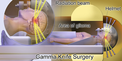 How Much Does Gamma Knife Surgery Cost?
