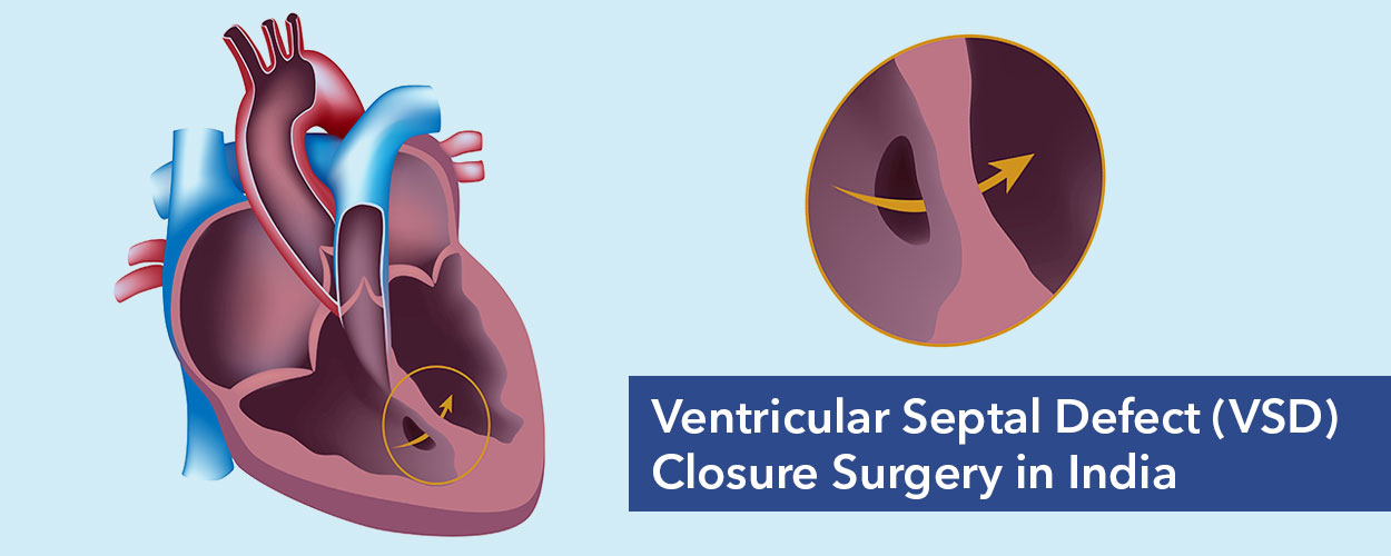 VSD Closure Surgery Cost in India