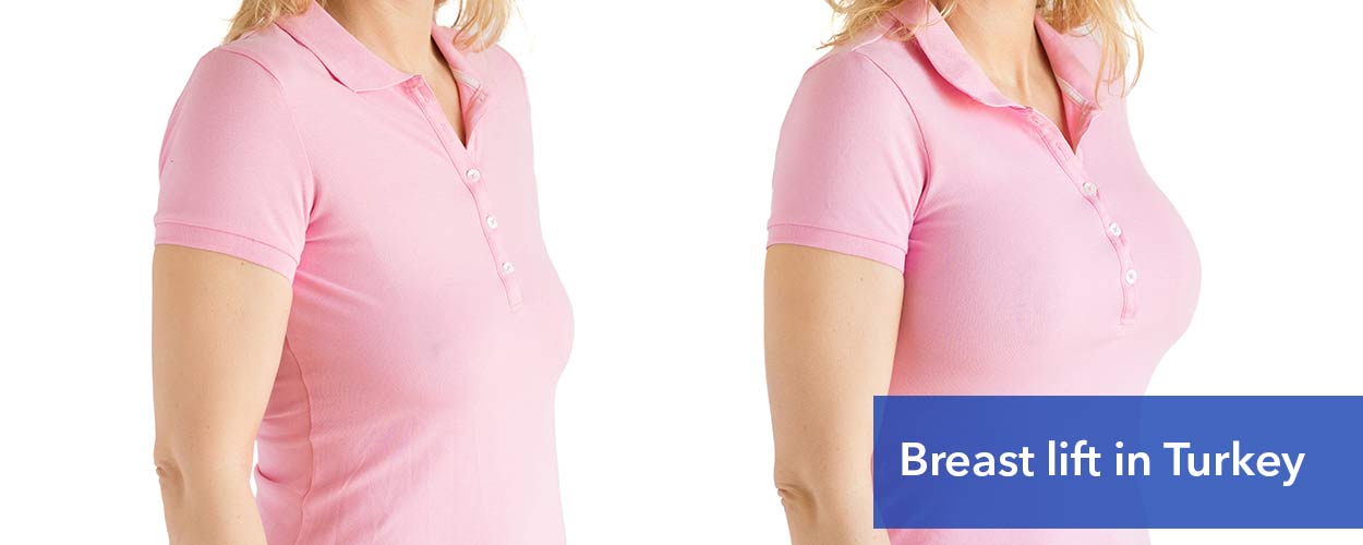 Breast Lift Cost in Turkey - 2024 Price Comparison