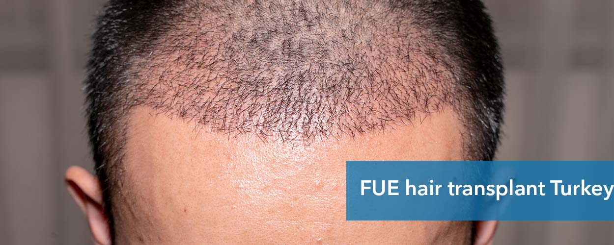 Hair Transplant in India Low Cost Hair Transplant India